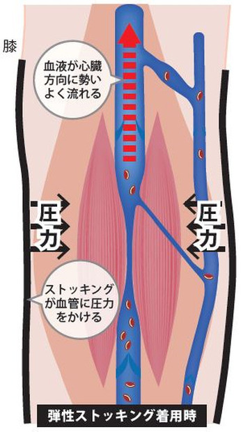 「JETLEGS」は一般医療機器として認定を受けており、市販のサポートストッキングよりも高い圧迫圧で血流をスムーズにする（画像はプレスリリースより）